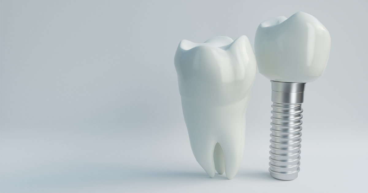 implant-dentar